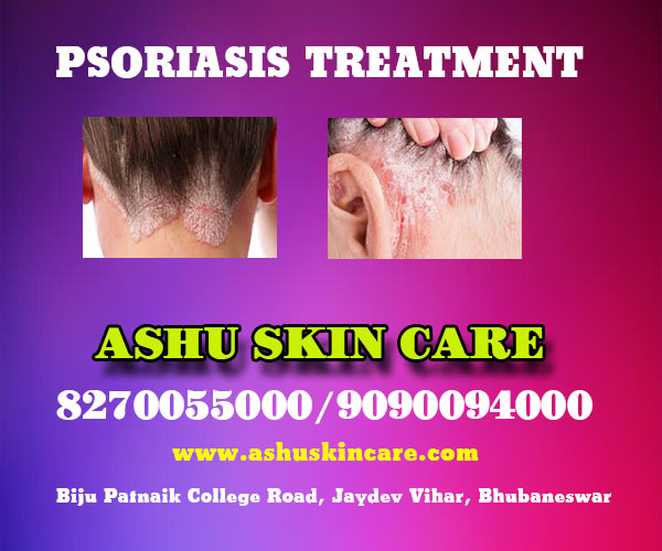 best psoriasis of scalp treatment clinic in bhubaneswar near me